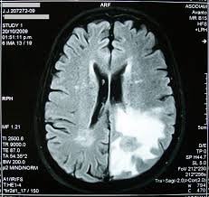 Brain-Tumour-1